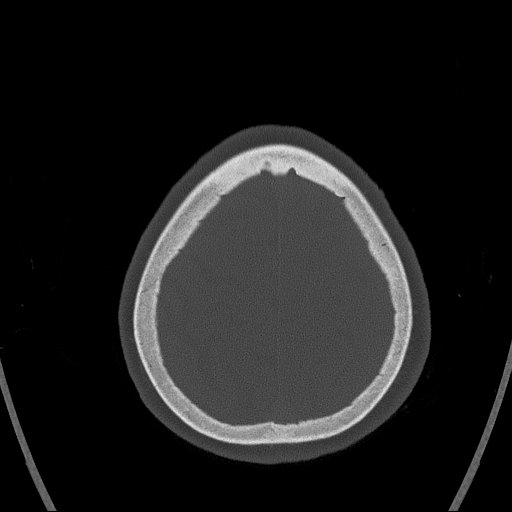 Cerebral venous infarction with hemorrhage (Radiopaedia 65343-74381 Axial bone window 164).jpg