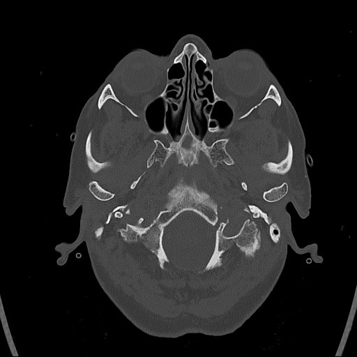 Cerebral venous infarction with hemorrhage (Radiopaedia 65343-74381 Axial bone window 5).jpg