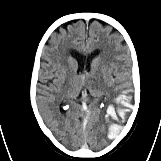 File:Cerebral venous infarction with hemorrhage (Radiopaedia 65343-74381 Axial non-contrast 13).jpg