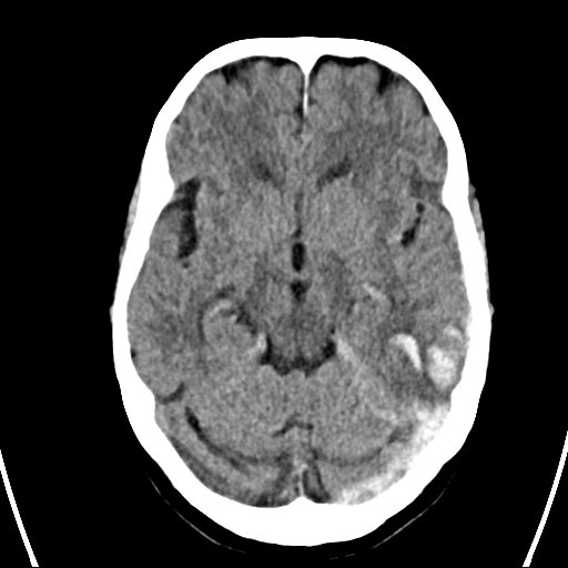 File:Cerebral venous infarction with hemorrhage (Radiopaedia 65343-74381 Axial non-contrast 9).jpg