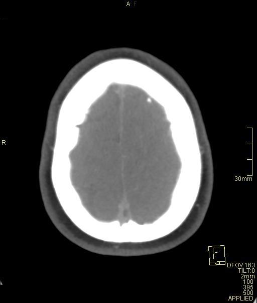 Cerebral venous sinus thrombosis (Radiopaedia 91329-108965 Axial venogram 70).jpg