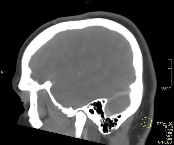 Cerebral venous sinus thrombosis (Radiopaedia 91329-108965 Sagittal venogram 16).jpg