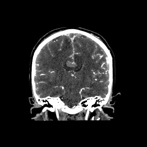 File:Cerebral venous throbmosis - hemorrhagic venous infarction (Radiopaedia 87318-103613 Coronal CT venogram 20).jpg
