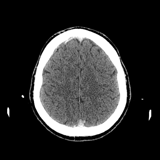File:Cerebral venous thrombosis (CVT) (Radiopaedia 77524-89685 Axial non-contrast 37).jpg
