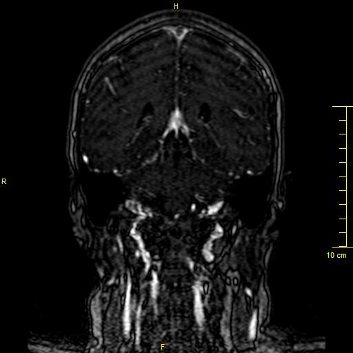 Cerebral venous thrombosis (Radiopaedia 23288-23351 MRV 102).JPG