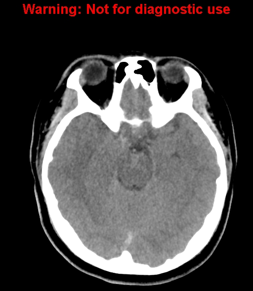 File:Cerebral venous thrombosis (Radiopaedia 37224-38992 Axial non-contrast 11).jpg