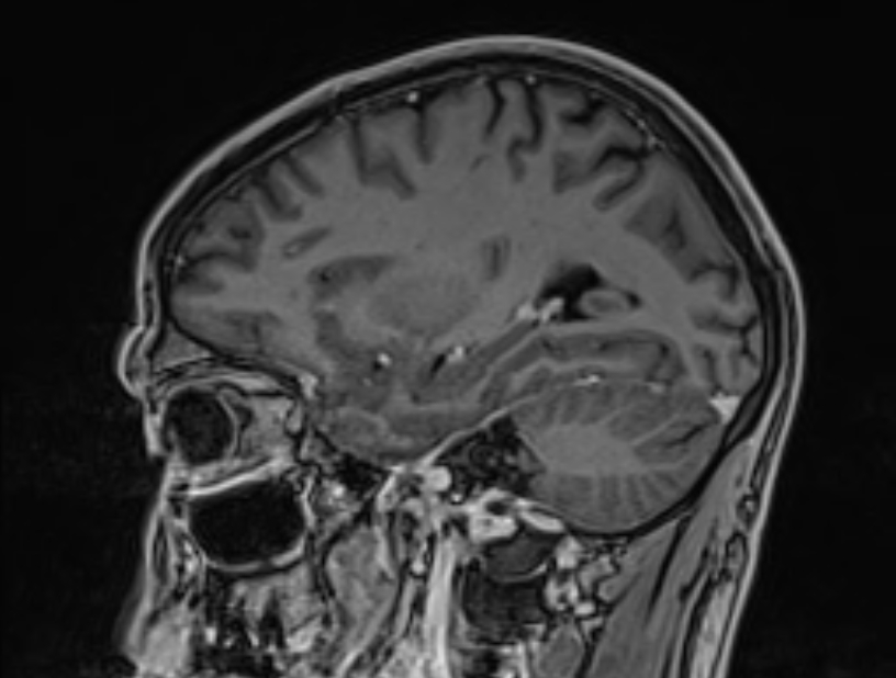 Cerebral venous thrombosis (Radiopaedia 71207-81504 Sagittal T1 C+ 18).jpg