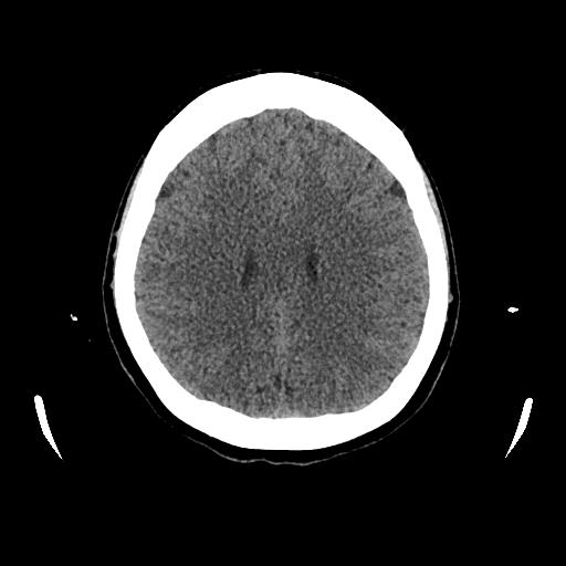 File:Cerebral venous thrombosis with venous hemorrhagic infarct (Radiopaedia 90354-107660 Axial non-contrast 34).jpg