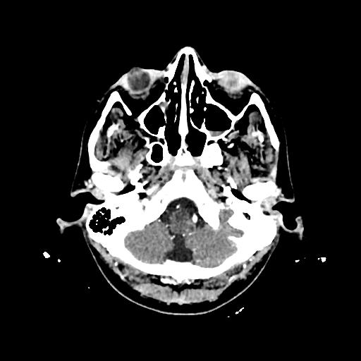 File:Cerebral venous thrombosis with venous hemorrhagic infarct (Radiopaedia 90354-107660 Axial with contrast 25).jpg