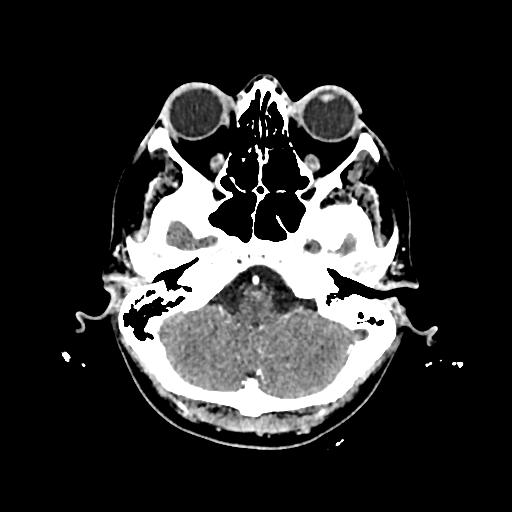 Cerebral venous thrombosis with venous hemorrhagic infarct (Radiopaedia 90354-107660 Axial with contrast 35).jpg