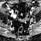 File:Cervical adenocarcinoma (Radiopaedia 65011-73985 Axial ADC 20).jpg