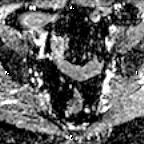 File:Cervical adenocarcinoma (Radiopaedia 65011-73985 Axial ADC 21).jpg