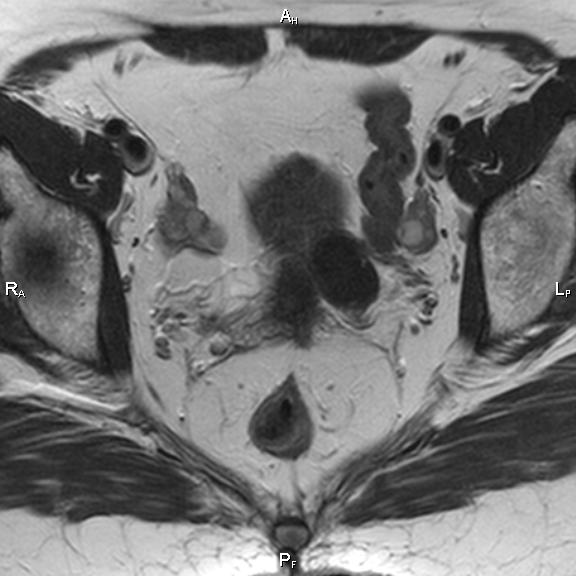 File:Cervical adenocarcinoma (Radiopaedia 65011-73985 Axial T2 22).jpg