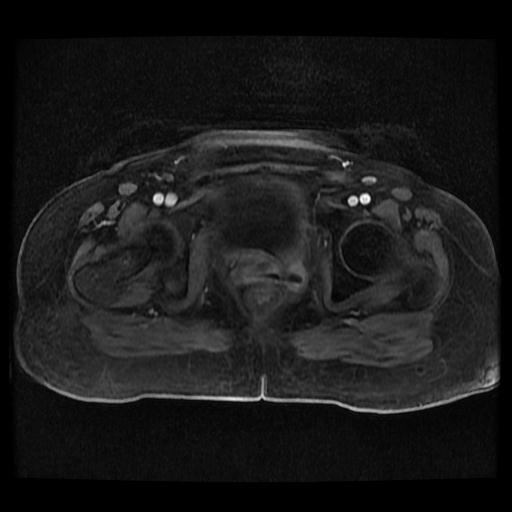 Cervical carcinoma (Radiopaedia 70924-81132 Axial T1 C+ fat sat 124).jpg