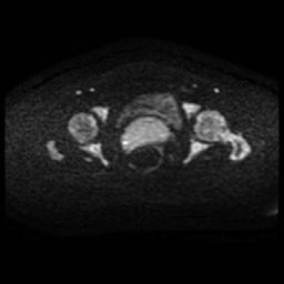 Cervical carcinoma (Radiopaedia 88010-104555 Axial DWI 67).jpg