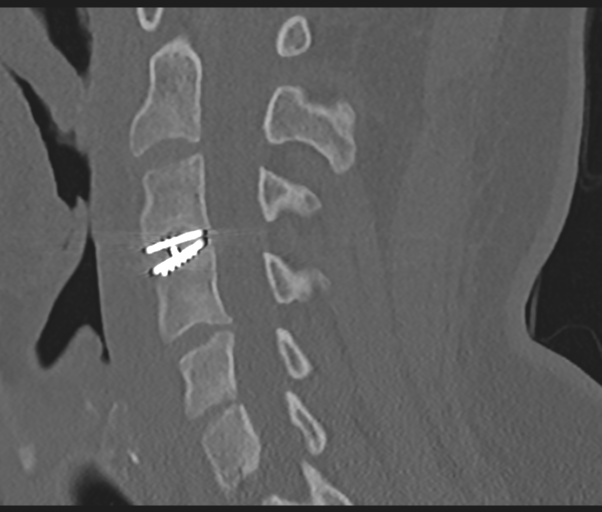 Cervical disc replacement (Radiopaedia 44025-47541 Sagittal bone window 47).png