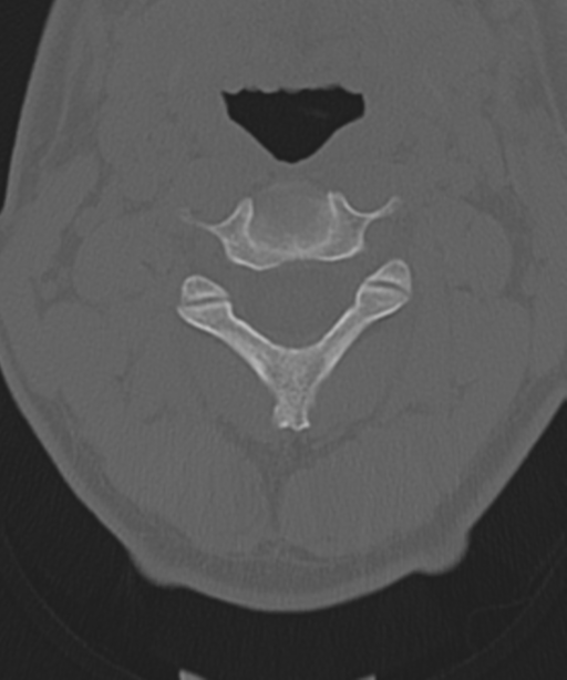 Cervical intercalary bone (Radiopaedia 35211-36748 Axial bone window 23).png