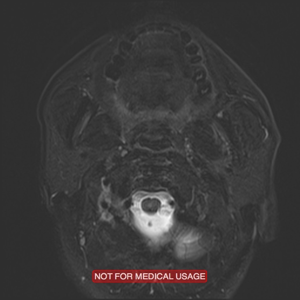Cervical nerve schwannoma (Radiopaedia 27964-28221 C 20).jpg