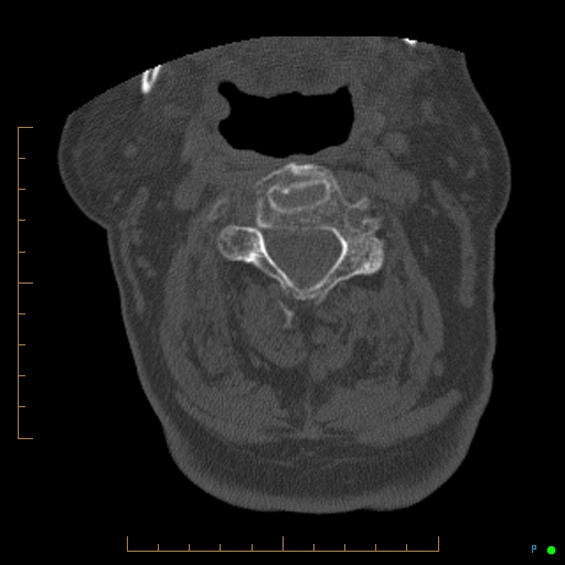File:Cervical spine fracture - ankylosing spondylitis (Radiopaedia 76835-88706 Axial bone window 79).jpg