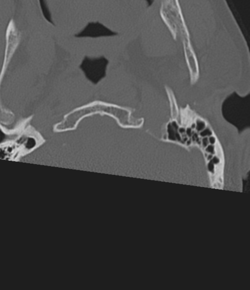 Cervical spine fracture in the setting of ankylosis (Radiopaedia 37038-38715 Axial bone window 5).png