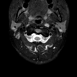 File:Cervical spine posterior ligamentous complex rupture (Radiopaedia 63486-72103 Axial T2 21).jpg