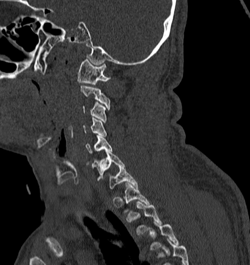 Cervical spine trauma with tear drop fracture and perched facet joint (Radiopaedia 53989-60127 Sagittal bone window 40).jpg