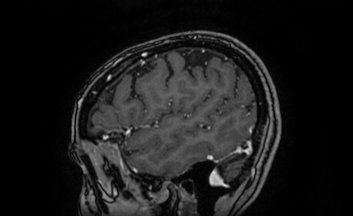 Cervical spondylodiscitis and calvarial hemangioma (Radiopaedia 64317-73103 Sagittal T1 C+ 62).jpg
