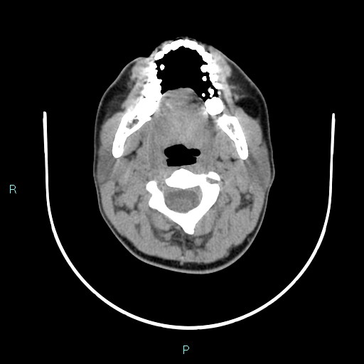 Cervical thymic cyst (Radiopaedia 88632-105335 Axial non-contrast 85).jpg