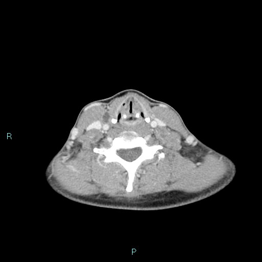 Cervical thymic cyst (Radiopaedia 88632-105335 C 49).jpg