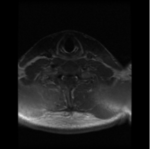 File:Cervical vertebrae metastasis (Radiopaedia 78814-91667 Axial T1 C+ 3).png