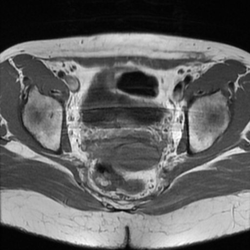 File:Cesarian section scar endometriosis (Radiopaedia 66520-75799 Axial T1 14).jpg