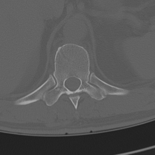 Chance fracture (Radiopaedia 33854-35020 Axial bone window 77).png
