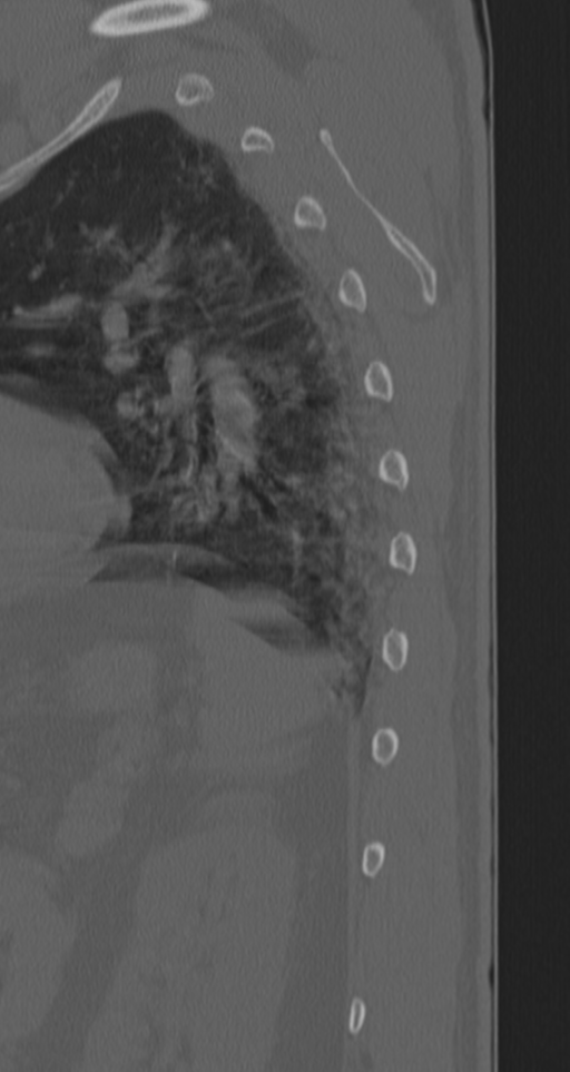 Chance fracture (Radiopaedia 33854-35020 Sagittal bone window 3).png