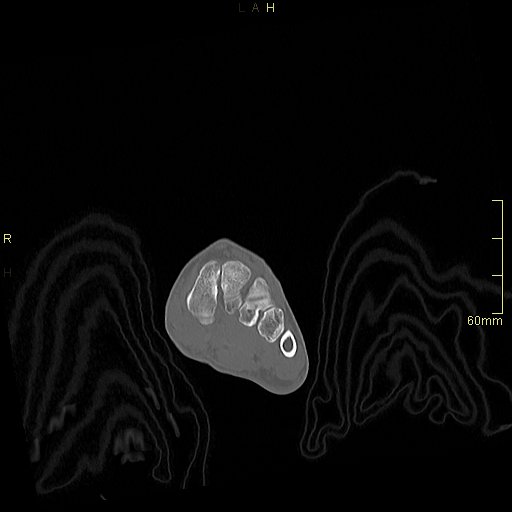Chaput tubercle fracture (Radiopaedia 80319-93956 Coronal non-contrast 11).jpg