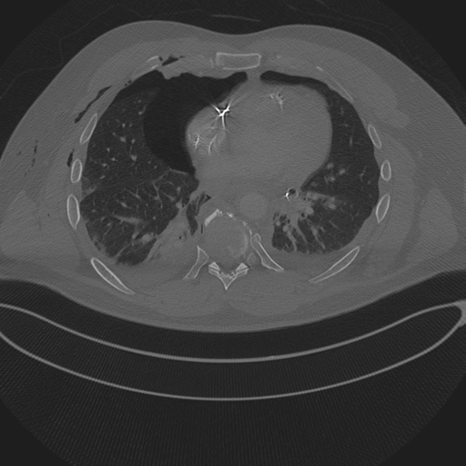 Chest multitrauma - aortic injury (Radiopaedia 34708-36147 Axial bone window 182).png