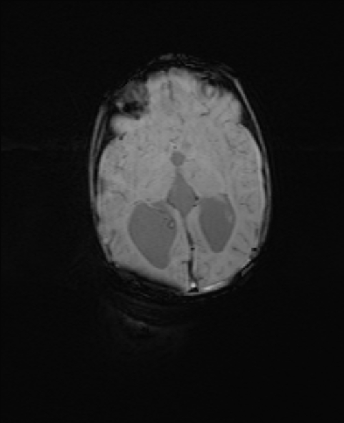 Chiari III malformation with occipital encephalocele (Radiopaedia 79446-92559 Axial SWI 37).jpg