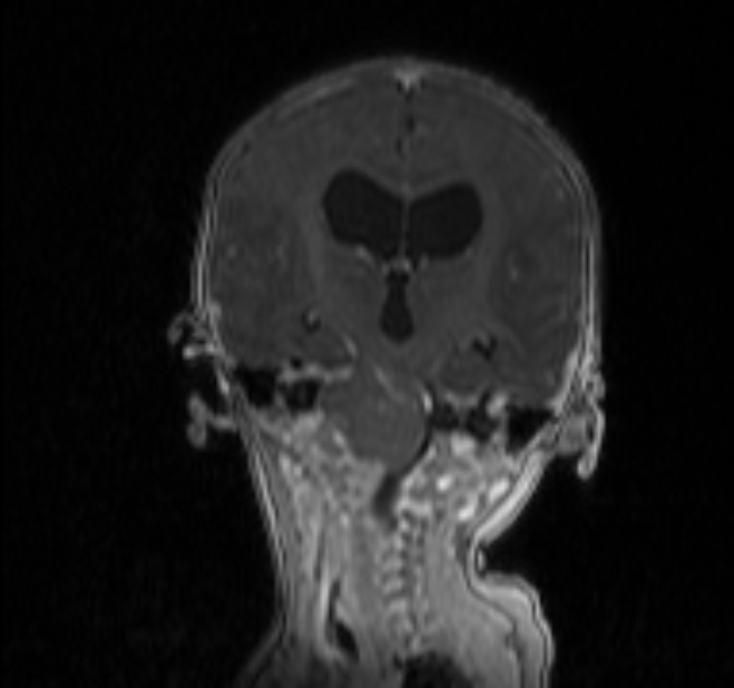 Chiari III malformation with occipital encephalocele (Radiopaedia 79446-92559 Coronal T1 C+ mpr 19).jpg