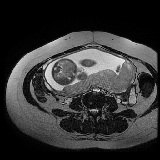 Chiari II malformation - fetal MRI (Radiopaedia 68099-77581 Axial Fiesta 12).jpg