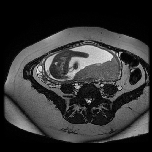 Chiari II malformation - fetal MRI (Radiopaedia 68099-77581 Axial Fiesta 27).jpg