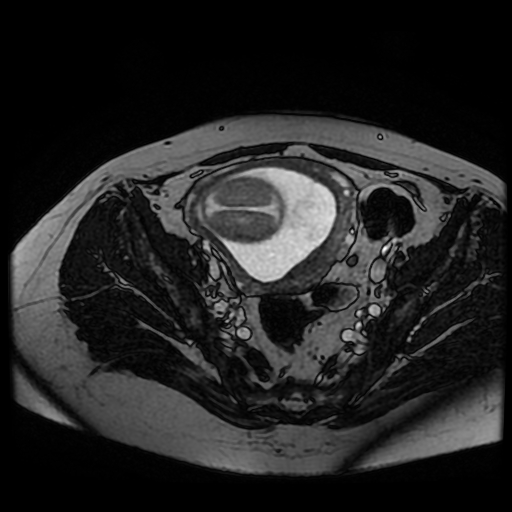 Chiari II malformation - fetal MRI (Radiopaedia 68099-77581 Axial Fiesta 47).jpg