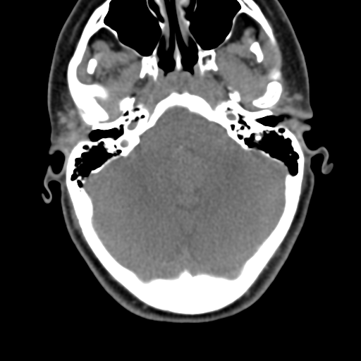 Chiari I malformation and obstructive hydrocephalus (Radiopaedia 41185-43981 D 25).png