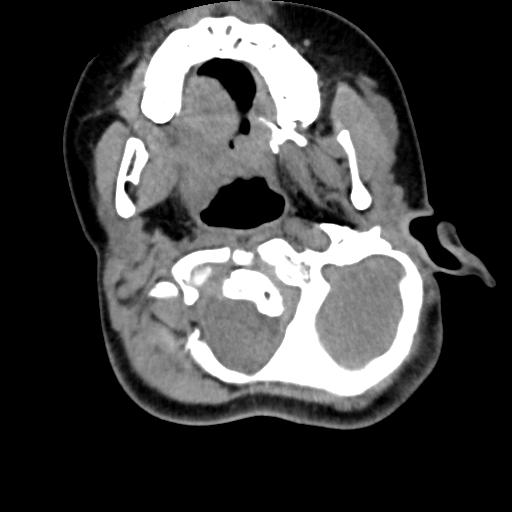 Chiari I with syrinx and skull base anomalies (Radiopaedia 89444-106412 Axial non-contrast 45).jpg