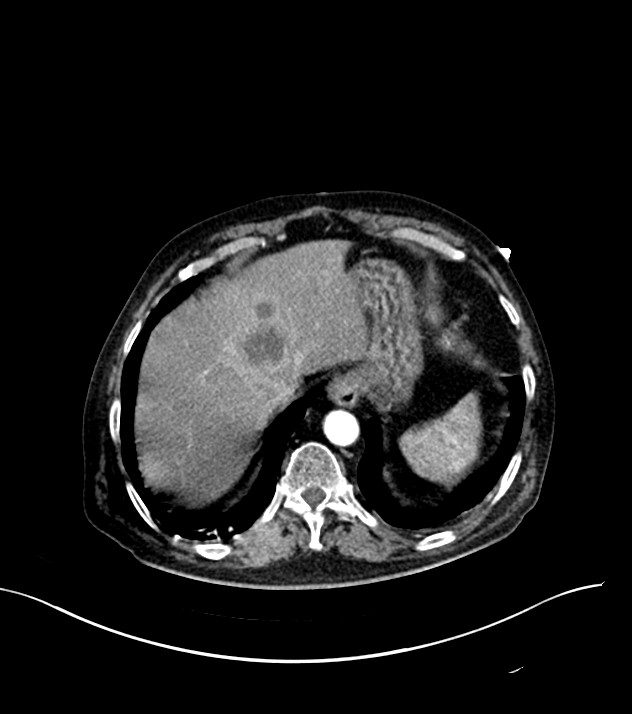 Cholangiocarcinoma with cerebral metastases (Radiopaedia 83519-98629 B 11).jpg