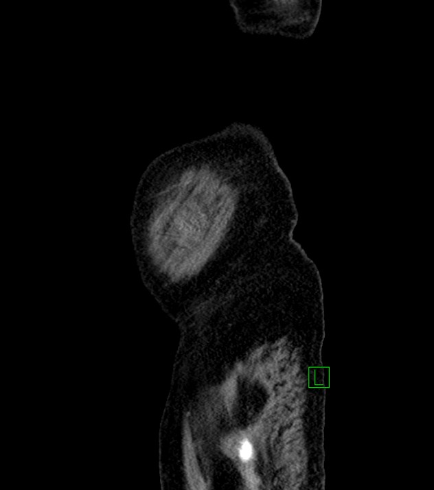 Cholangiocarcinoma with cerebral metastases (Radiopaedia 83519-98629 F 114).jpg