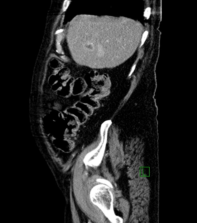 Cholangiocarcinoma with cerebral metastases (Radiopaedia 83519-98629 F 97).jpg