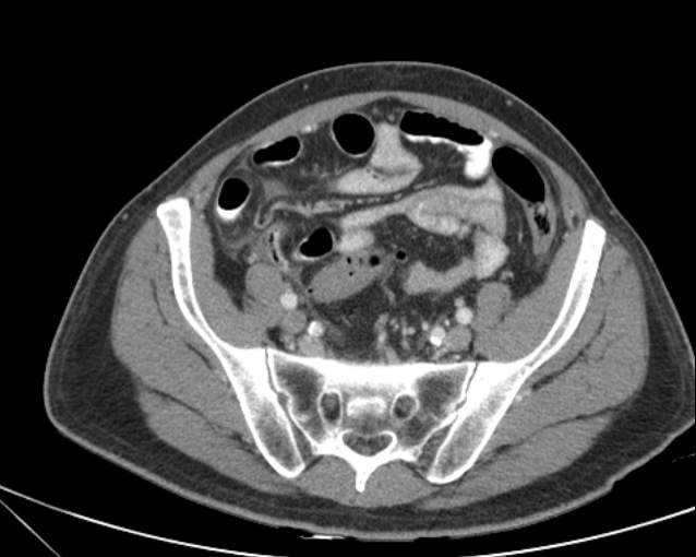 Cholecystitis - perforated gallbladder (Radiopaedia 57038-63916 A 64).jpg