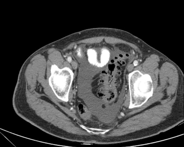 Cholecystitis - perforated gallbladder (Radiopaedia 57038-63916 A 74).jpg