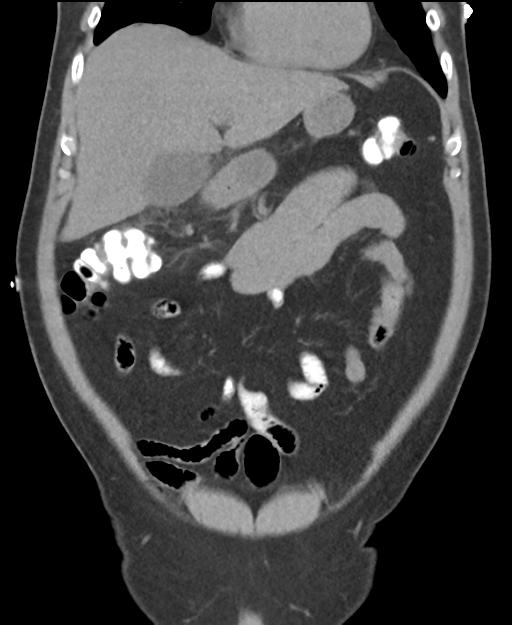 Cholecystitis with focal perforation and hepatic abscess (Radiopaedia 37189-38945 Coronal non-contrast 18).png