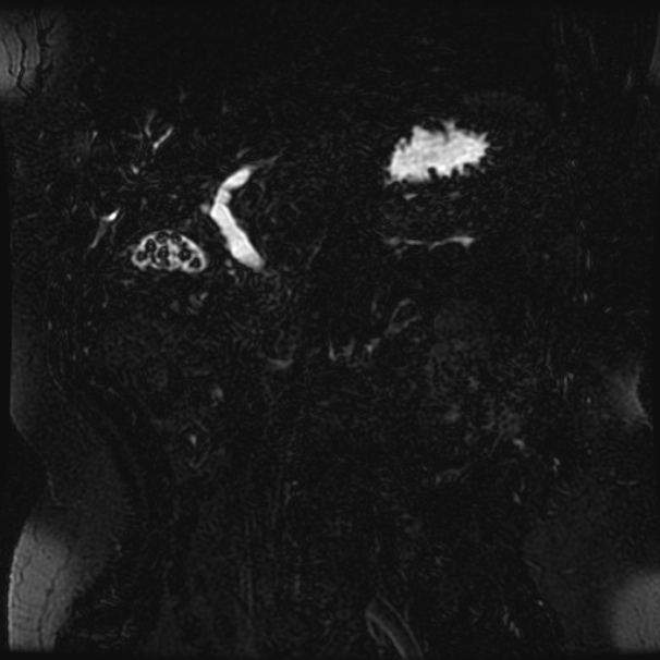 Choledocholithiasis on CT and MRI (Radiopaedia 24825-25088 Coronal T2 42).jpg