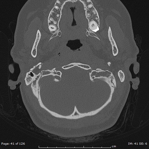 Cholesteatoma - external auditory canal (Radiopaedia 88452-105096 Axial bone window 4).jpg